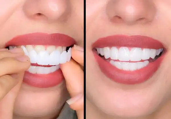 secret-veneers.jpg